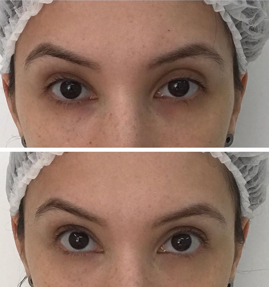 Behandlungsbeispiel Vorher Nachher Dermatologie Hanau